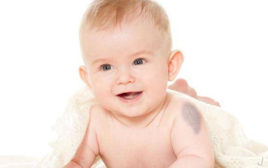 宝宝有这4种胎记伤害健康 越早消除越放心 - 健
