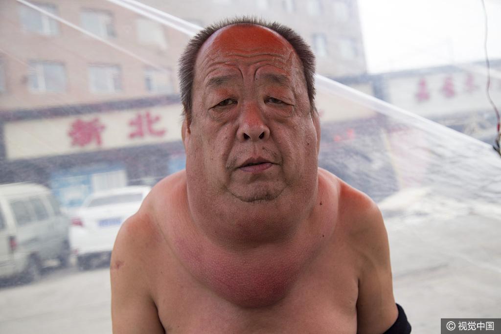 吉林市一农民患脂肪瘤13年 状如河马苦不堪言