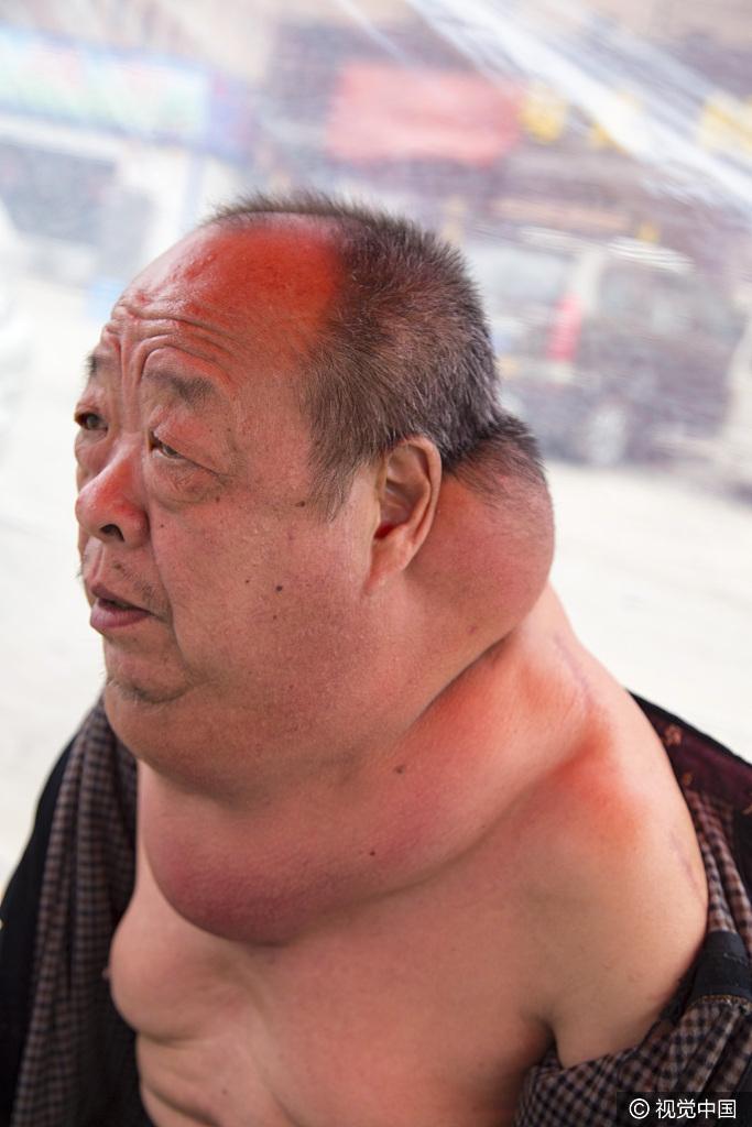 吉林市一农民患脂肪瘤13年 状如河马苦不堪言
